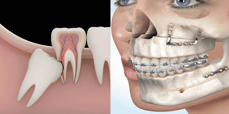 Cirugía Oral y Maxilofacial