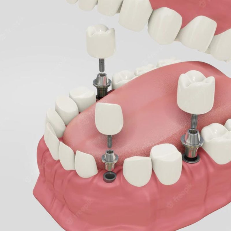 implantesdentales-dentyexpress implantesdentales-dentyexpress