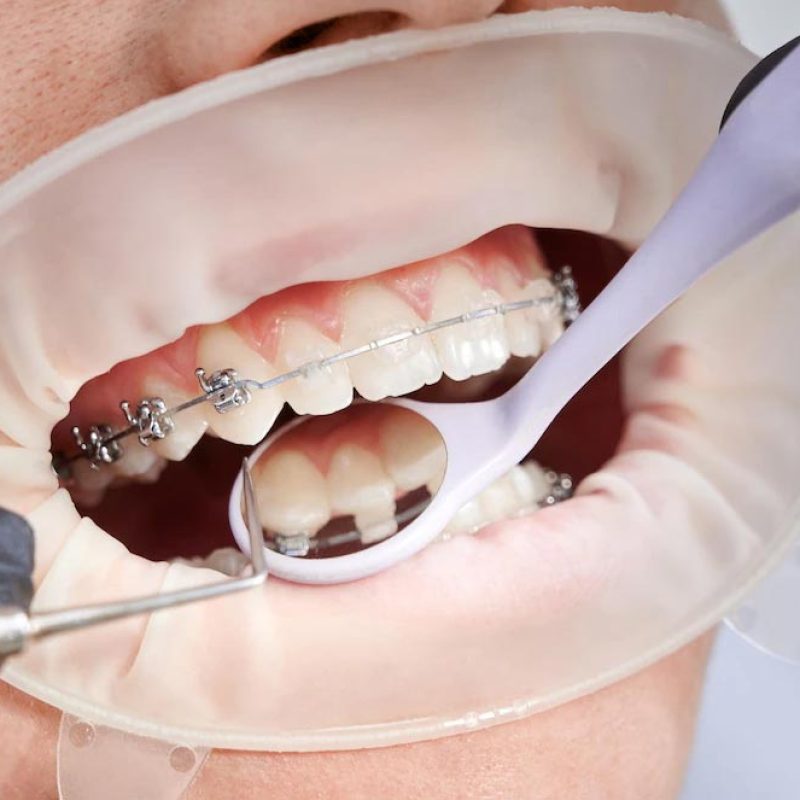 ortodoncia-procedimientodentyexpress